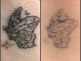 Лазерное удаление тату от 900 ₽