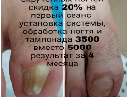 Титановая нить и обработка ногтя   - 30%