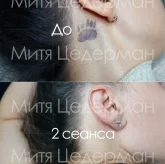 Клиника удаления татуировок и татуажа бровей Мити Цедермана фото 6